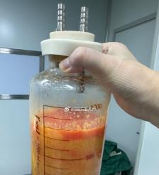 安岳水动力吸脂手术要做多久？